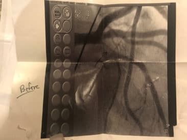 Photo of LDA Before Balloon - 06/11/2017