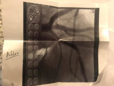 Photo of LDA After Balloon - 06/11/2017